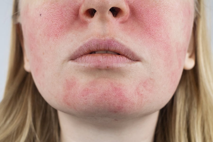 Eczeem of psoriasis